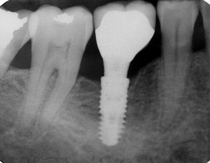 Problème dentaire : comment retrouver le sourire ?